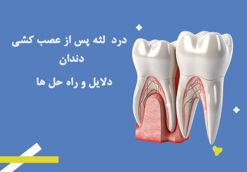 عصب کشی دندان