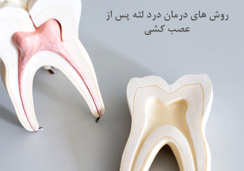 عصب کشی