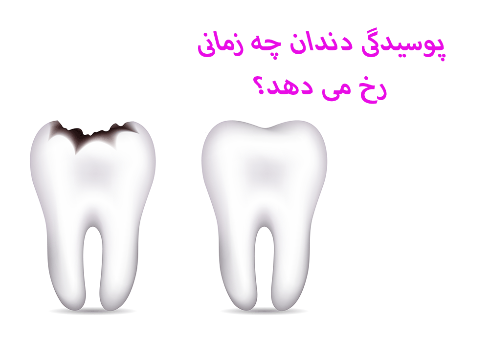 پوسیدگی دندان