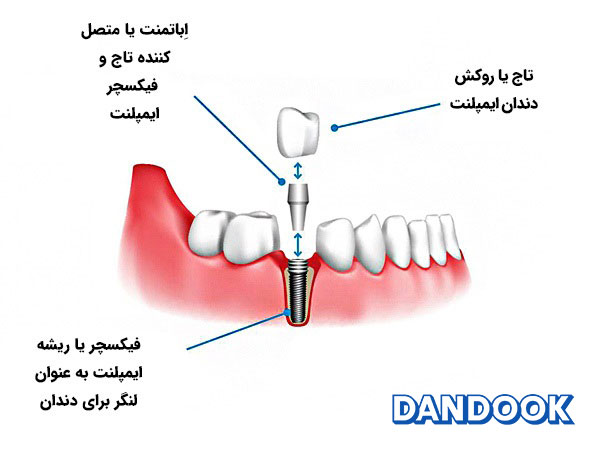 مواد و کالاهای ایمپلنت از ابزار های مواد و تجهیزات دندانپزشکی