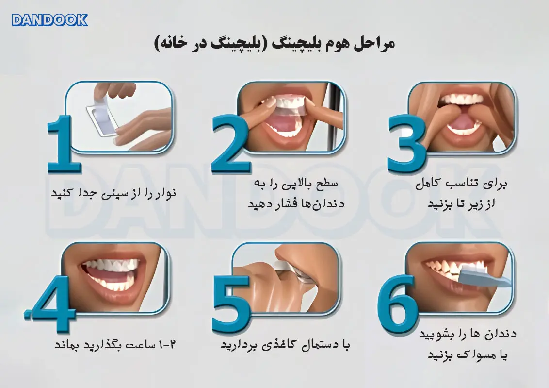 هزینه بلیچینگ دندان در خانه و مراحل آن