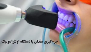 جرم گیری دندان با دستگاه اولتراسونیک