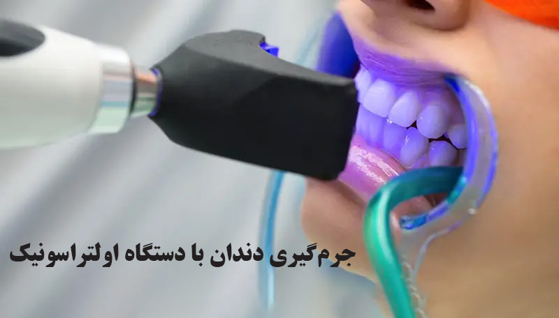 جرم گیری دندان با دستگاه اولتراسونیک
