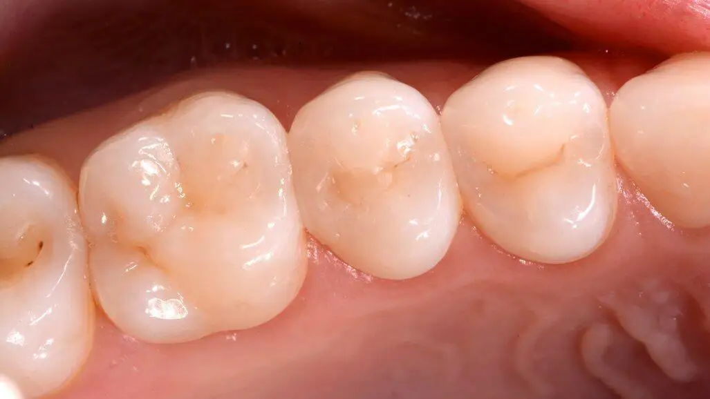 کامپوزیت میکروهیبرید (Micro-Hybrid)